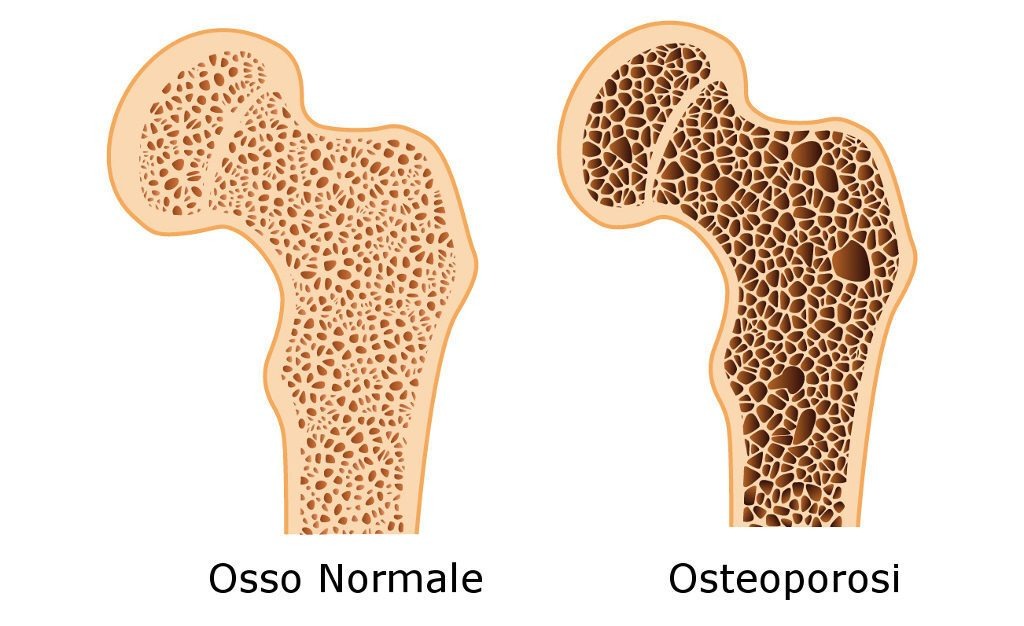 Osteoporosi: meglio prevenire che curare